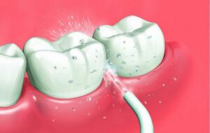 Іригатор для зубів з насадкою, що подає струмінь води для очищення міжзубних проміжків та ясен.