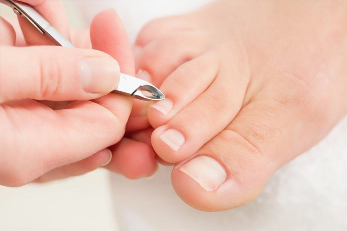 Грибок ногтей