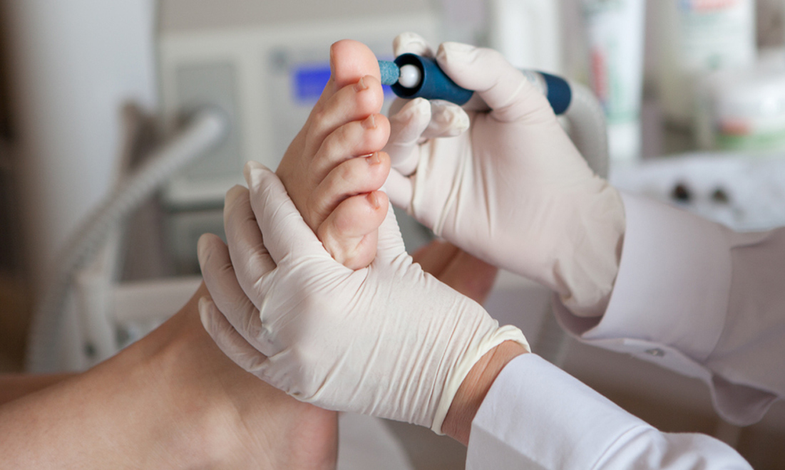 Лечение грибка ногтей на ногах