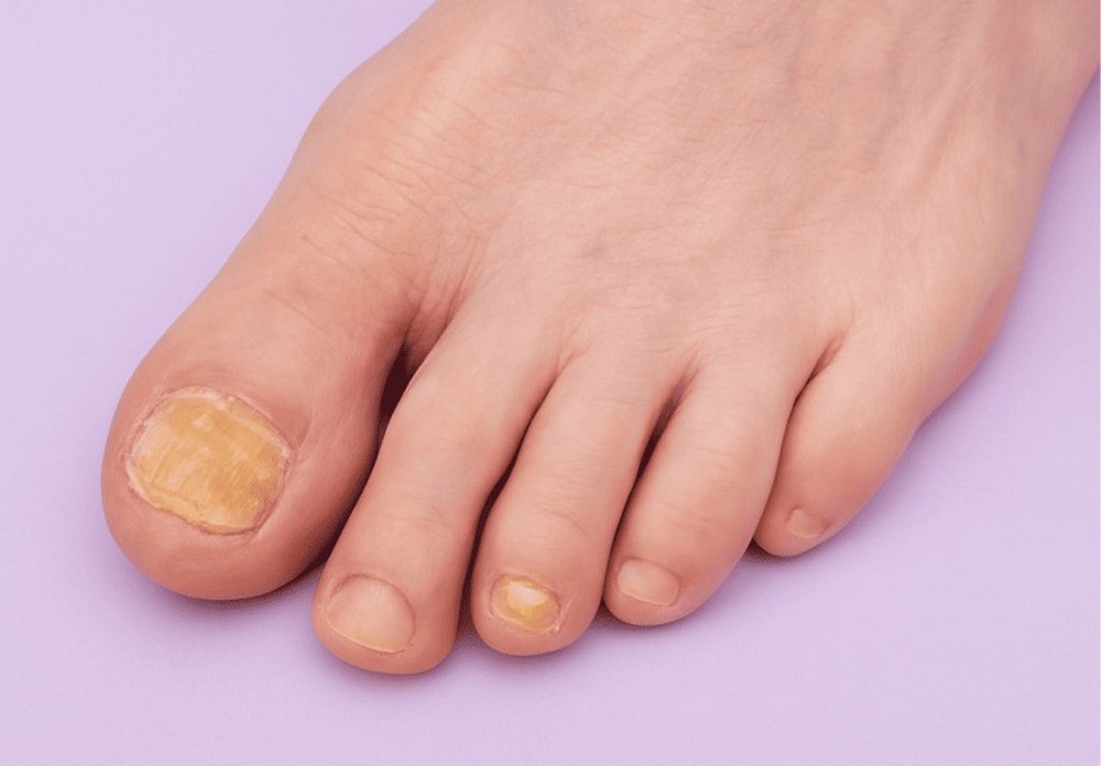 Лечение грибка ногтей